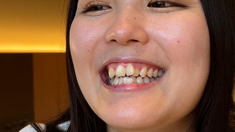 街角で声をかけて口内観察させてもらう カフェ店員 ひなちゃん サンプル画像 21